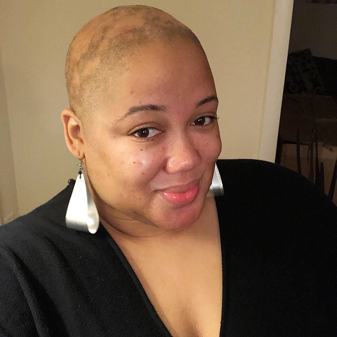 Life with Androgenetic Alopecia 